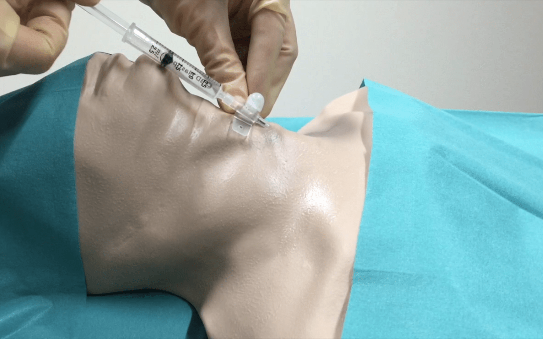 Needle Cricothyroidotomy